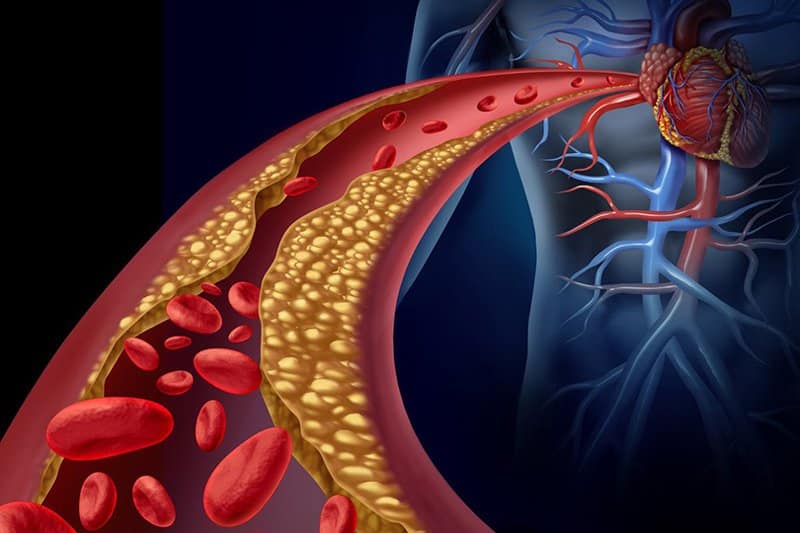 ما هو مرض الكوليسترول؟