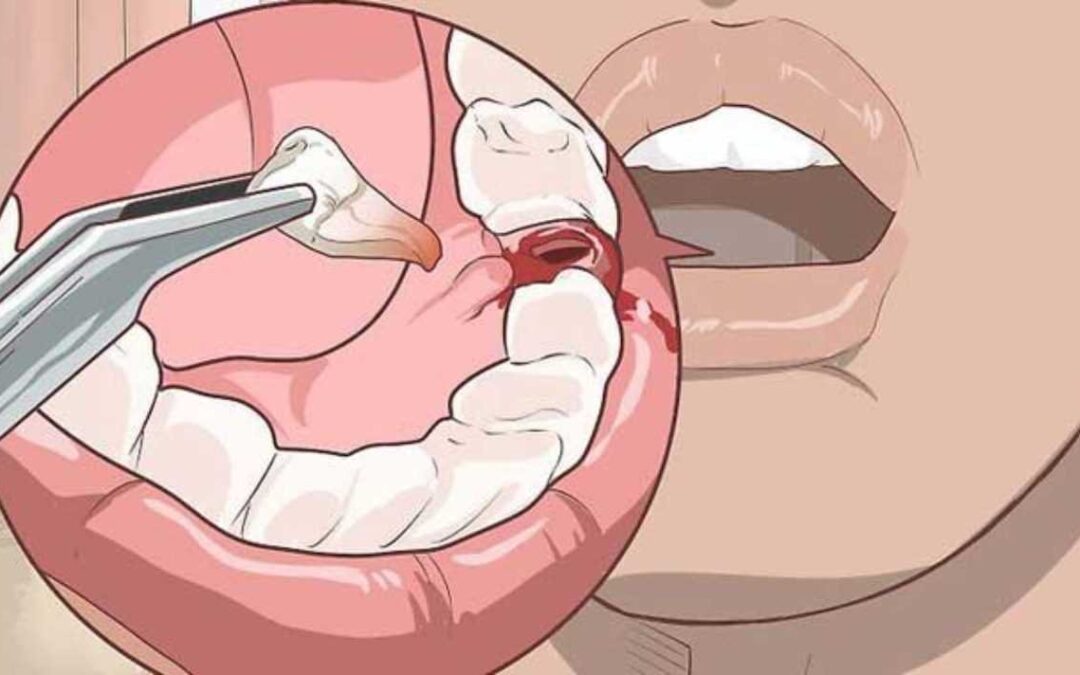 قلع الأسنان الدائمية.. أسبابه وآثاره