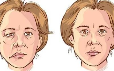 مرض العصب السابع… شلل الوجه النصفي
