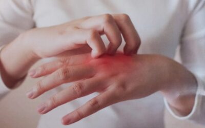 أشهر الأمراض الجلدية: الحساسية العصبية
