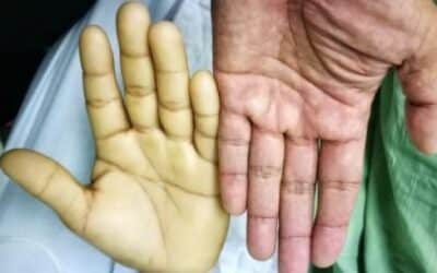 علاج فقر الدم بالغذاء